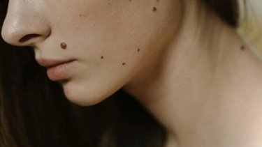 Правда ли, что люди с большим количеством родинок живут дольше?